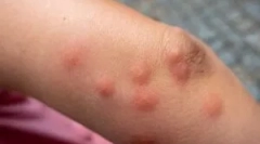 Алергія для укусу claop