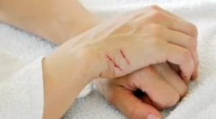 Захворювання, передані через укуси та подряпини