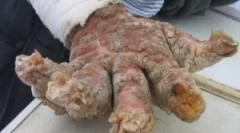 Що таке небезпечний філіоз: симптоми та лікування