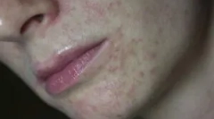 Демодекоз: що це таке, симптоми та лікування