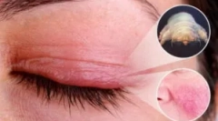 Демодекоз: причини, симптоми та лікування