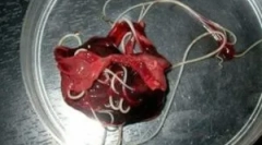 Черв'яки в тканинах печінки