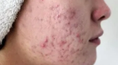 Як передається демодекоз?