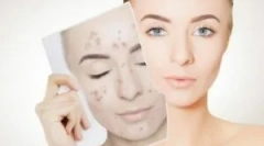 Лікування демодикозу на обличчі людини