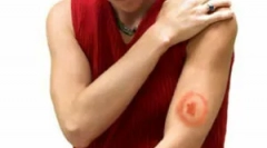 Лікування бореліозу кліщів