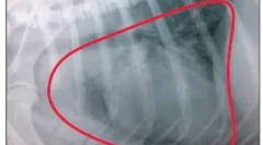 Пухлини легенів