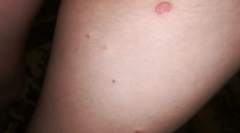 Чому деякі люди кусають бліх, і немає інших