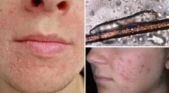 Аналіз доставки на демодекоз