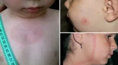 Симптоми та лікування бореліозу у дитини