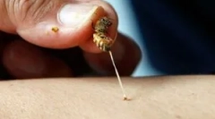 Кошти з укусів у великобританії