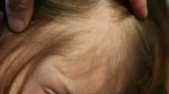 Воші та шорти в її волоссі у дитини